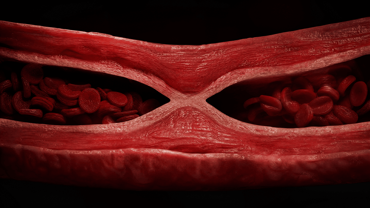 Reduced blood flow